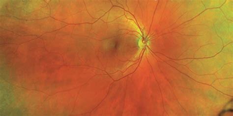 optos ultra widefield retinal imaging